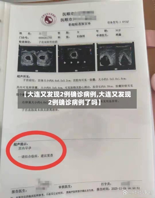 【大连又发现2例确诊病例,大连又发现2例确诊病例了吗】